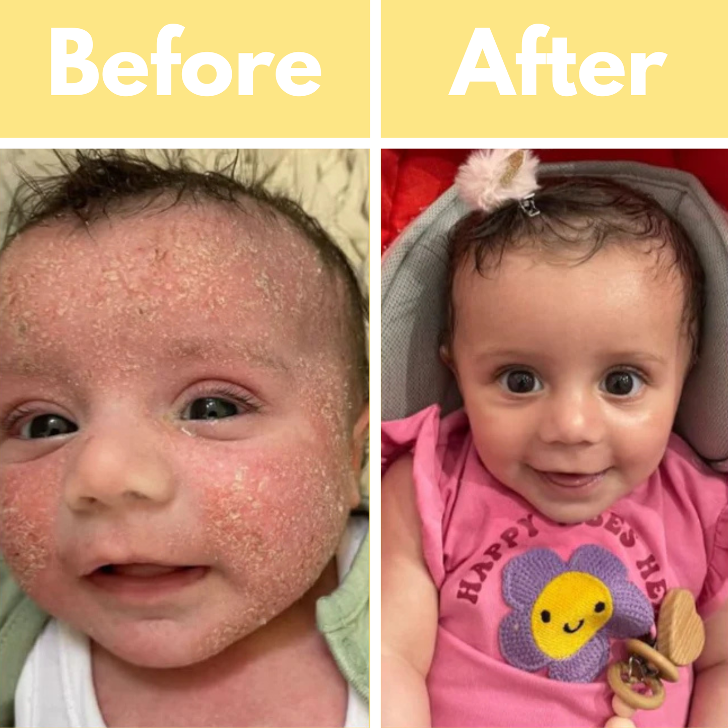 CliniBee Honey & Oatmeal Eczema Cream