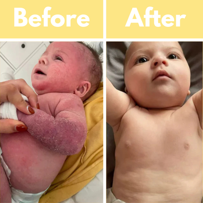 CliniBee Honey & Oatmeal Eczema Cream